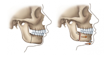 orthognathic jaw surgery melbourne