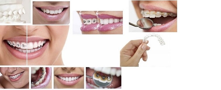 Cheap Lingual Orthodontics Melbourne