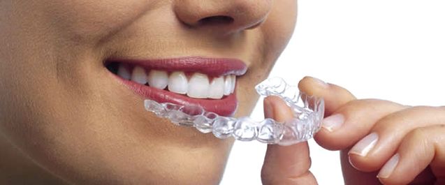 Cheap teeth retainers Melbourne
