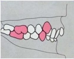 Class ii div ii underbite treatment melbourne