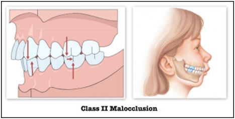 Class ii overbite treatment melbourne