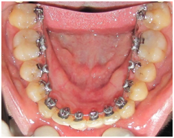 Lingual Braces Boxhill