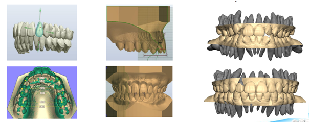 lingual braces melbourne