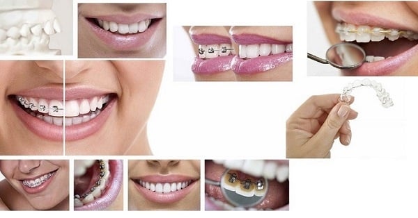 orthodontist free consultation